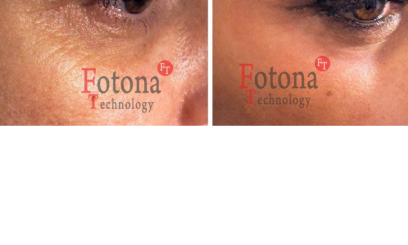 Фотона Глаза 6